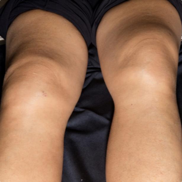 Arthritis